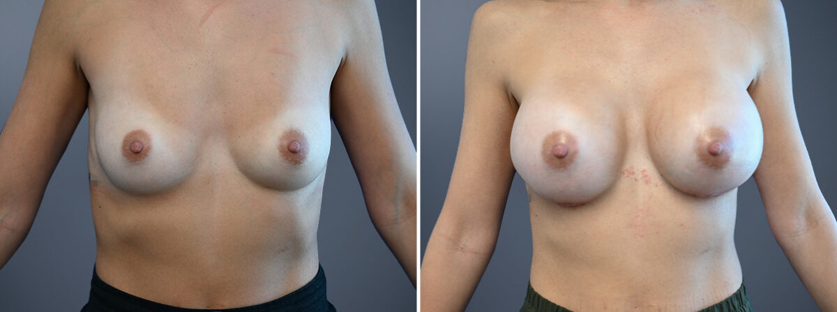 Before and after Breast Augmentation by Dr. David W. Allison, Patient 6772