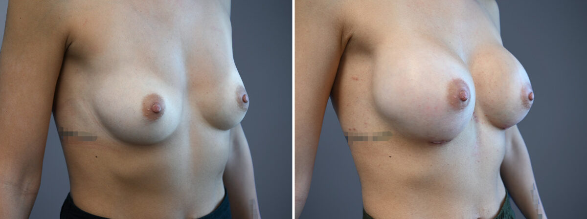 Before and after Breast Augmentation by Dr. David W. Allison, Patient 6772