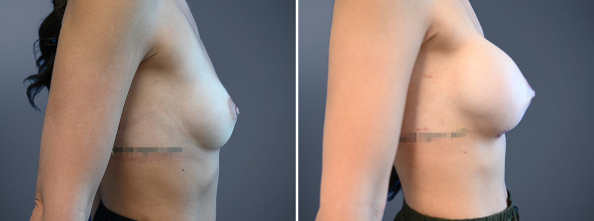 Before and after Breast Augmentation by Dr. David W. Allison, Patient 6772