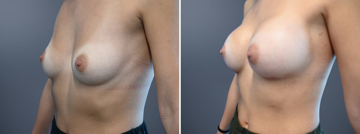 Before and after Breast Augmentation by Dr. David W. Allison, Patient 6772