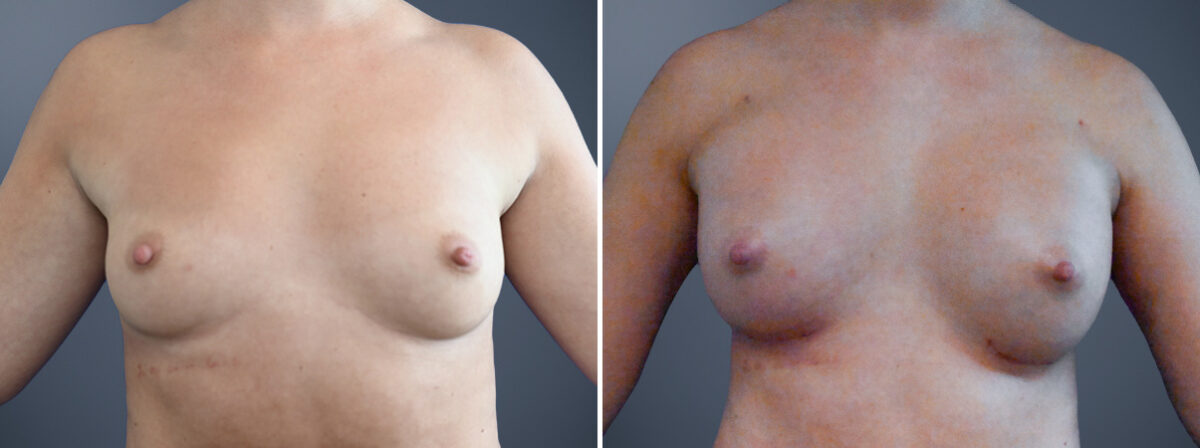 Before and after Breast Augmentation by Dr. David W. Allison, Patient 7217