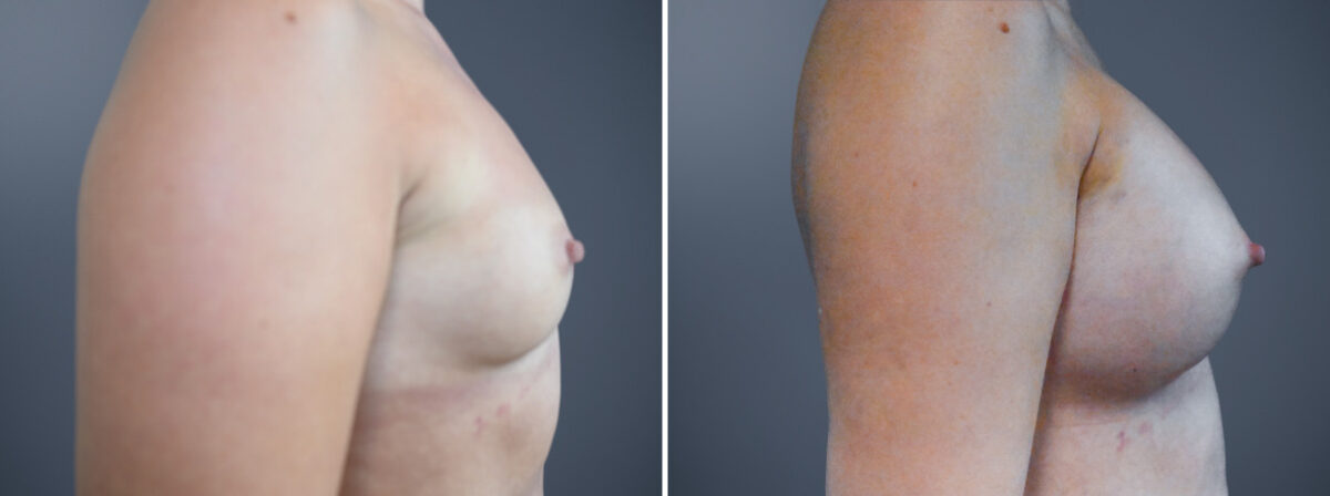 Before and after Breast Augmentation by Dr. David W. Allison, Patient 7217