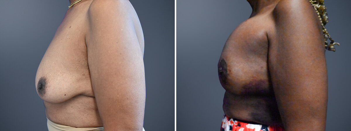 Before and after Breast Augmentation by Dr. David W. Allison, Patient 7225