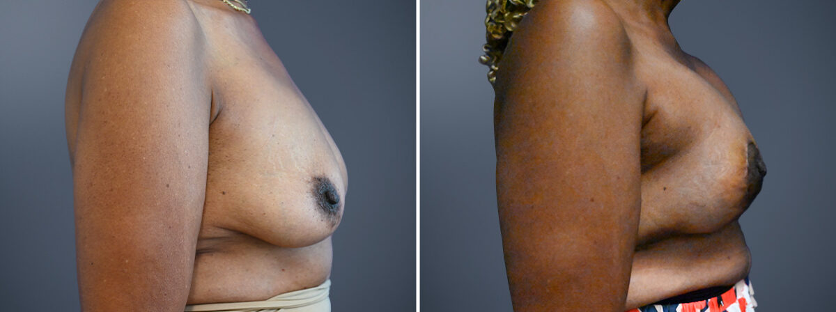 Before and after Breast Augmentation by Dr. David W. Allison, Patient 7225