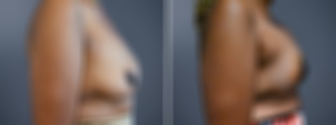 Before and after Breast Augmentation by Dr. David W. Allison, Patient 7225