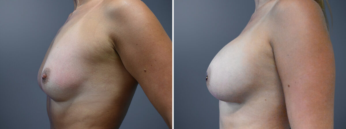 Before and after Breast Augmentation by Dr. David W. Allison, Patient 7236