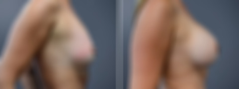 Before and after Breast Augmentation by Dr. David W. Allison, Patient 7236