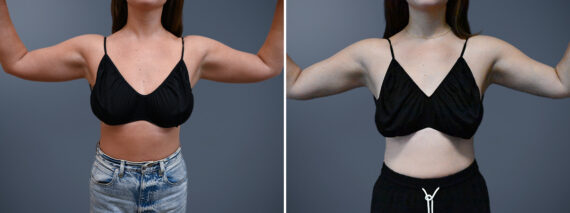 Before and after Arm Liposuction by Dr. David W. Allison, Patient 7246