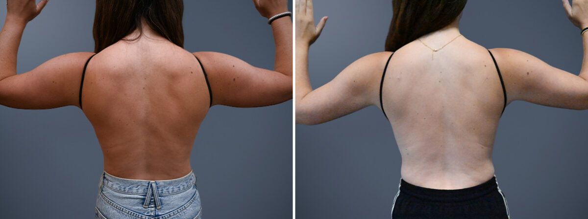 Before and after Arm Liposuction by Dr. David W. Allison, Patient 7246