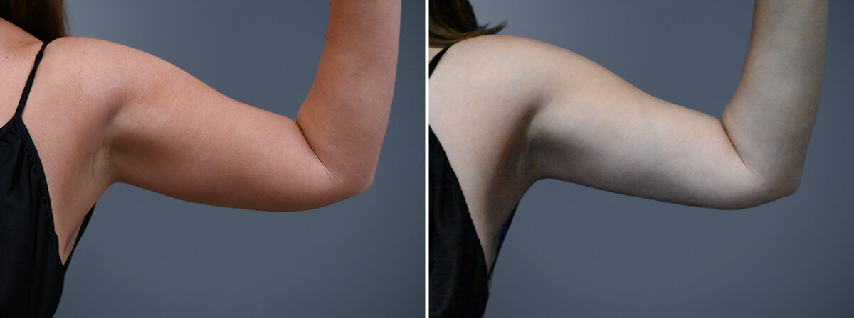 Before and after Arm Liposuction by Dr. David W. Allison, Patient 7246