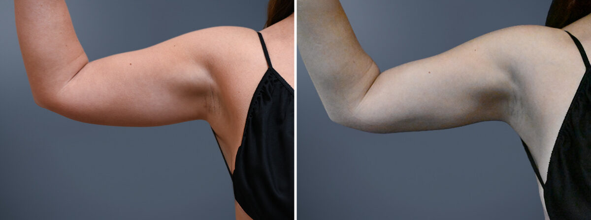 Before and after Arm Liposuction by Dr. David W. Allison, Patient 7246