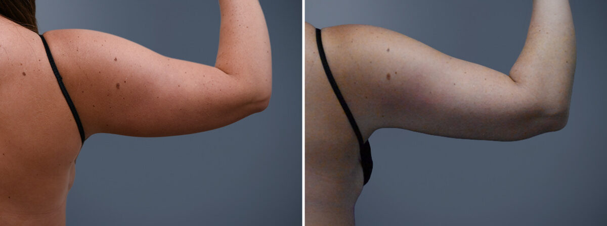 Before and after Arm Liposuction by Dr. David W. Allison, Patient 7246
