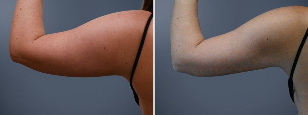 Before and after Arm Liposuction by Dr. David W. Allison, Patient 7246