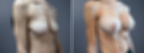Before and after Breast Augmentation by Dr. David W. Allison, Patient 7267
