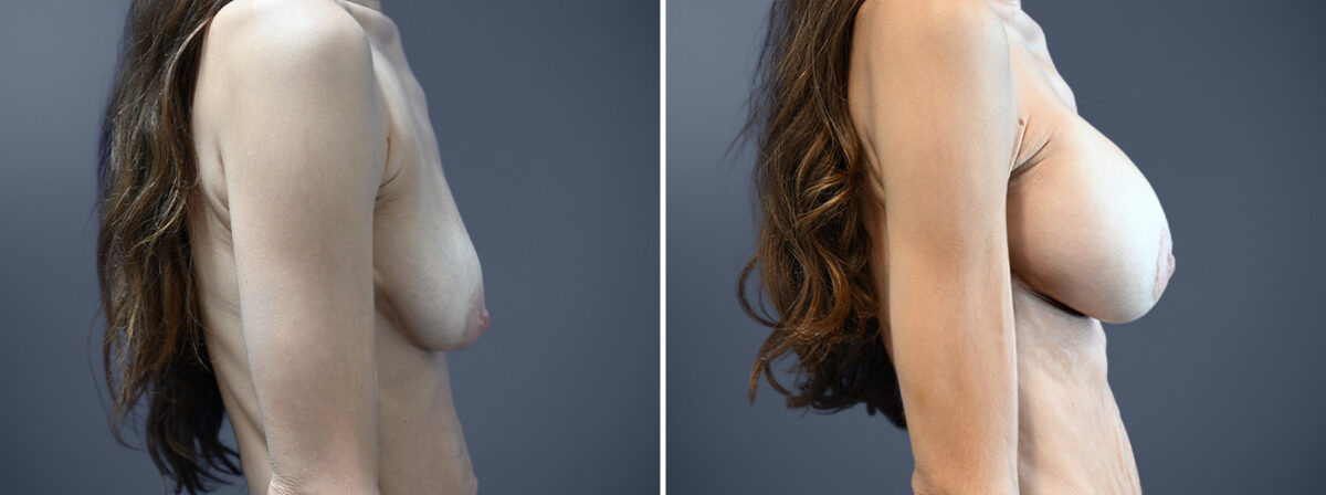Before and after Breast Augmentation by Dr. David W. Allison, Patient 7267