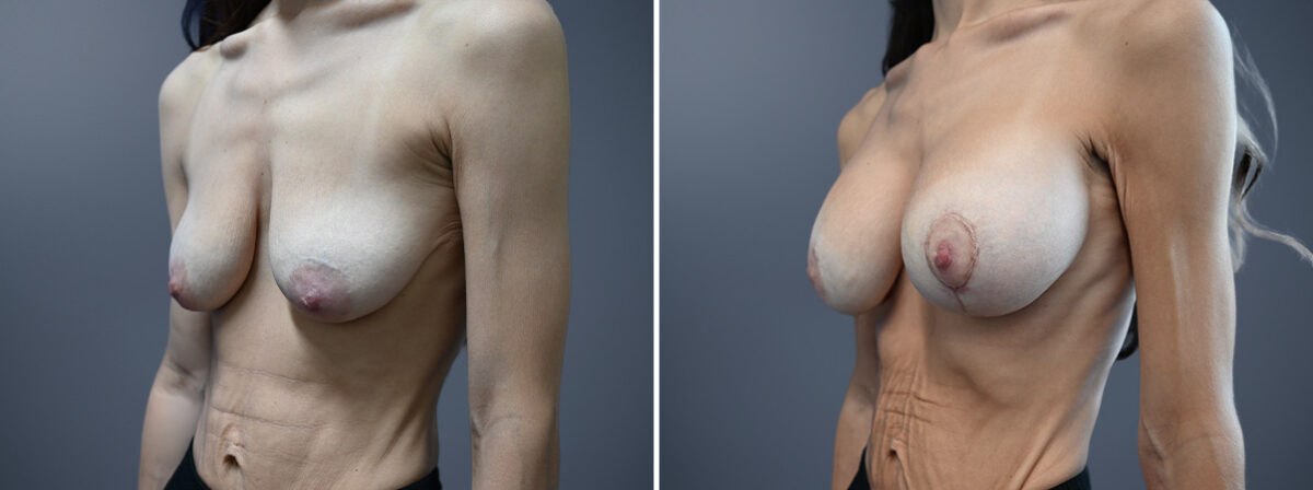 Before and after Breast Augmentation by Dr. David W. Allison, Patient 7267