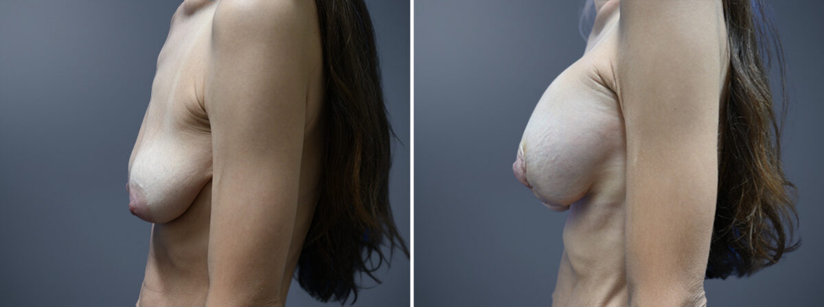 Before and after Breast Augmentation by Dr. David W. Allison, Patient 7267