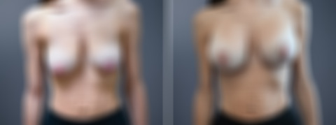 Before and after Breast Augmentation by Dr. David W. Allison, Patient 7267