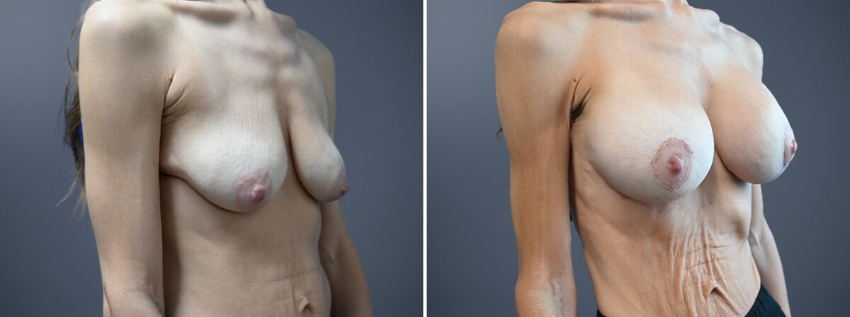 Before and after Breast Augmentation by Dr. David W. Allison, Patient 7267